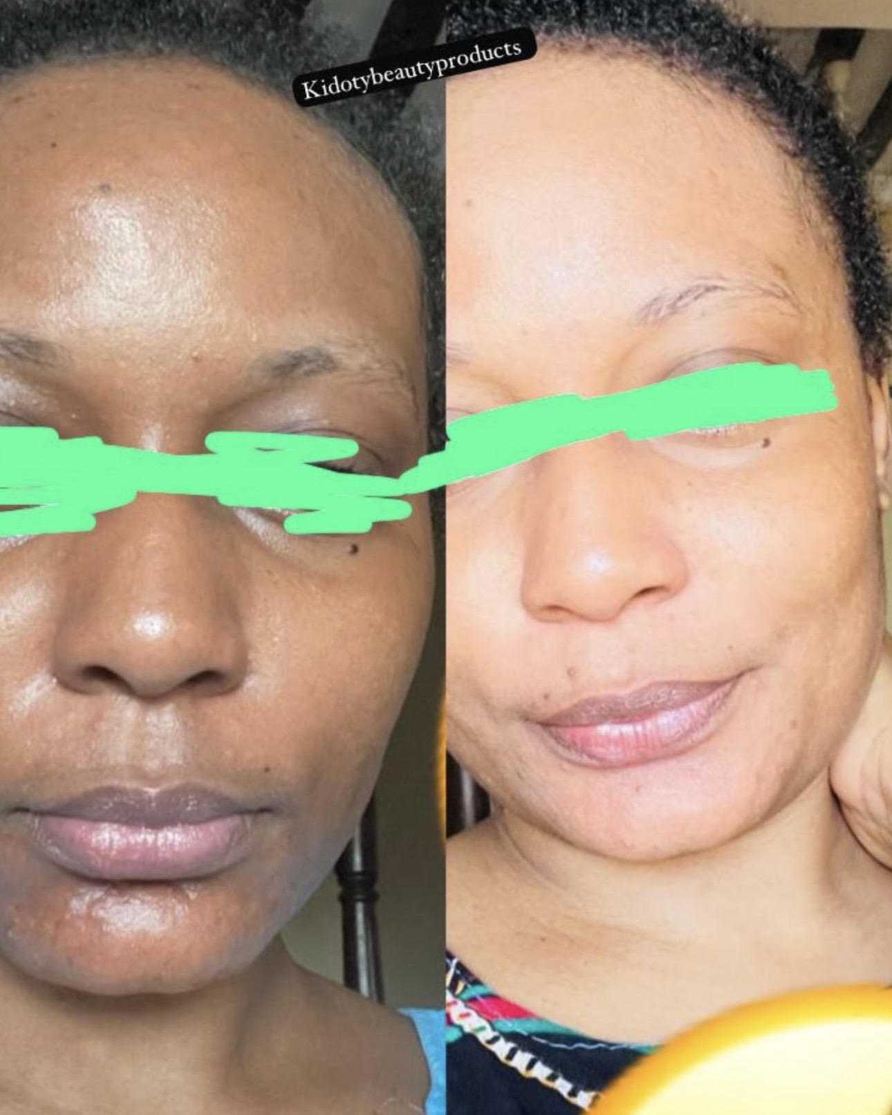 Kidoty Skin Care client-shared face progress