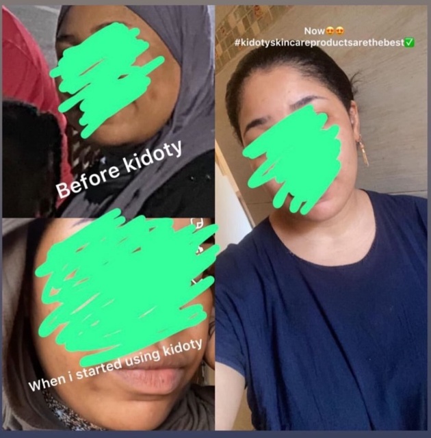 Kidoty Skin Care before and after customer result