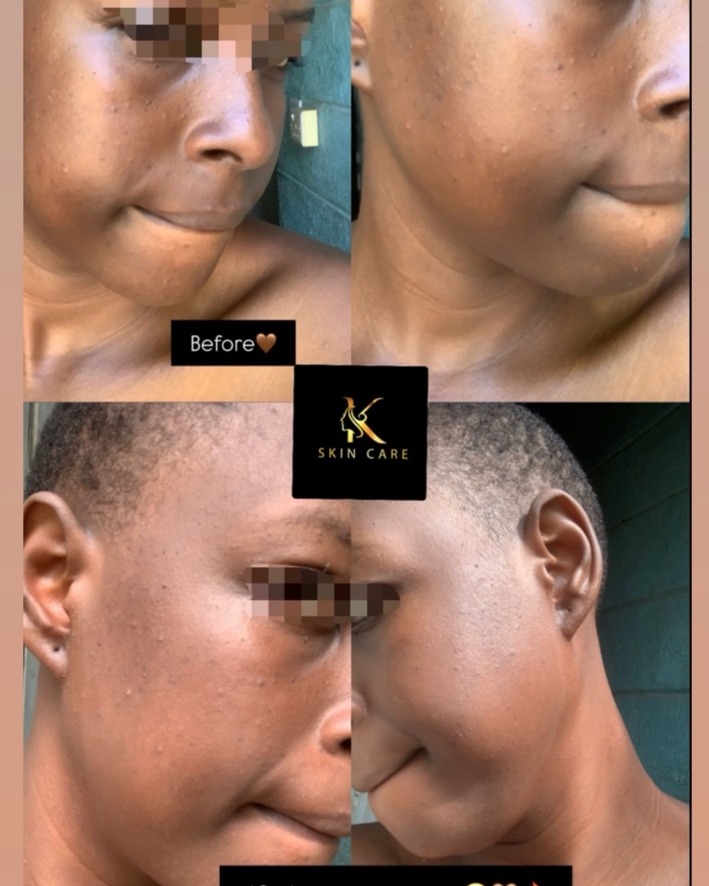 Kidoty Skin Care before and after progress