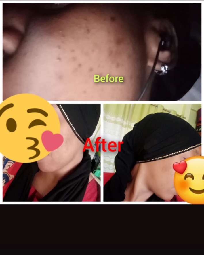 Kidoty Skin Care customer before and after content